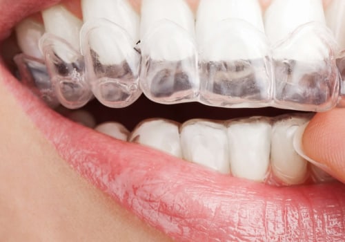 Do Invisible Aligners Really Work?