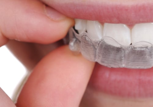 Are Clear Teeth Aligners Safe and Effective?