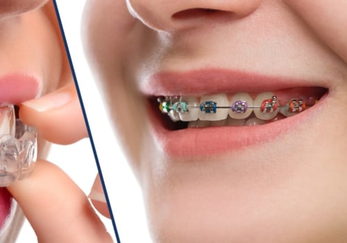 The Benefits of Clear Aligners Over Braces