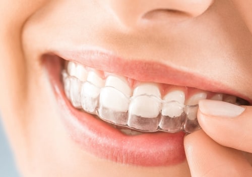 Can Clear Aligners Give You a Perfect Smile?