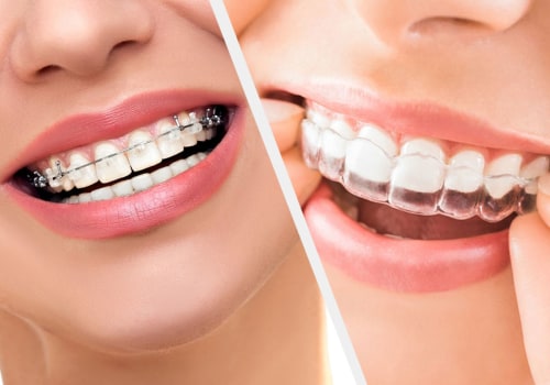 Why do aligners work faster than braces?