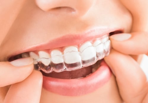 How Much Does Clear Aligners UK Cost?