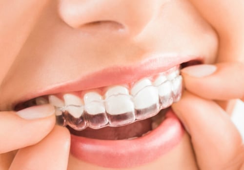 How Long Does it Take for Spark Clear Aligners to Work?