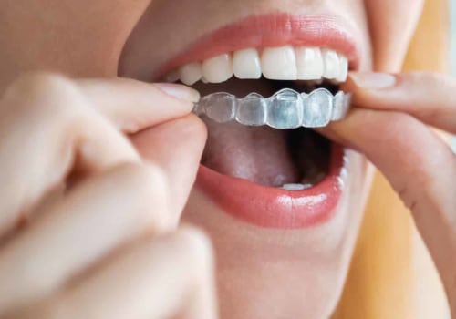 How Much Does it Cost to Get Spark Clear Aligners?