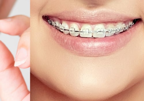 Are Clear Aligners Noticeable? An Expert's Perspective